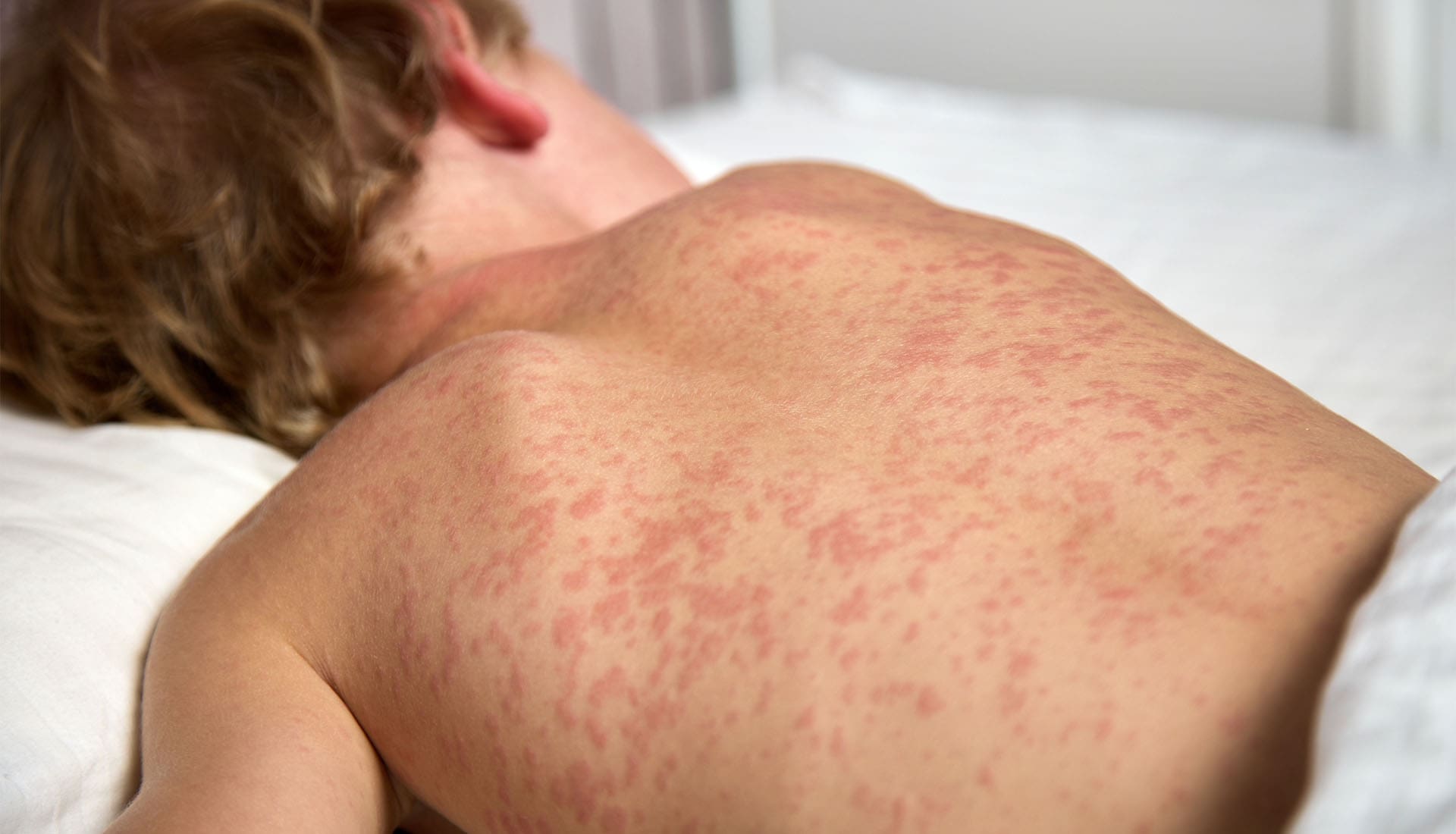 boy with measles 1920w